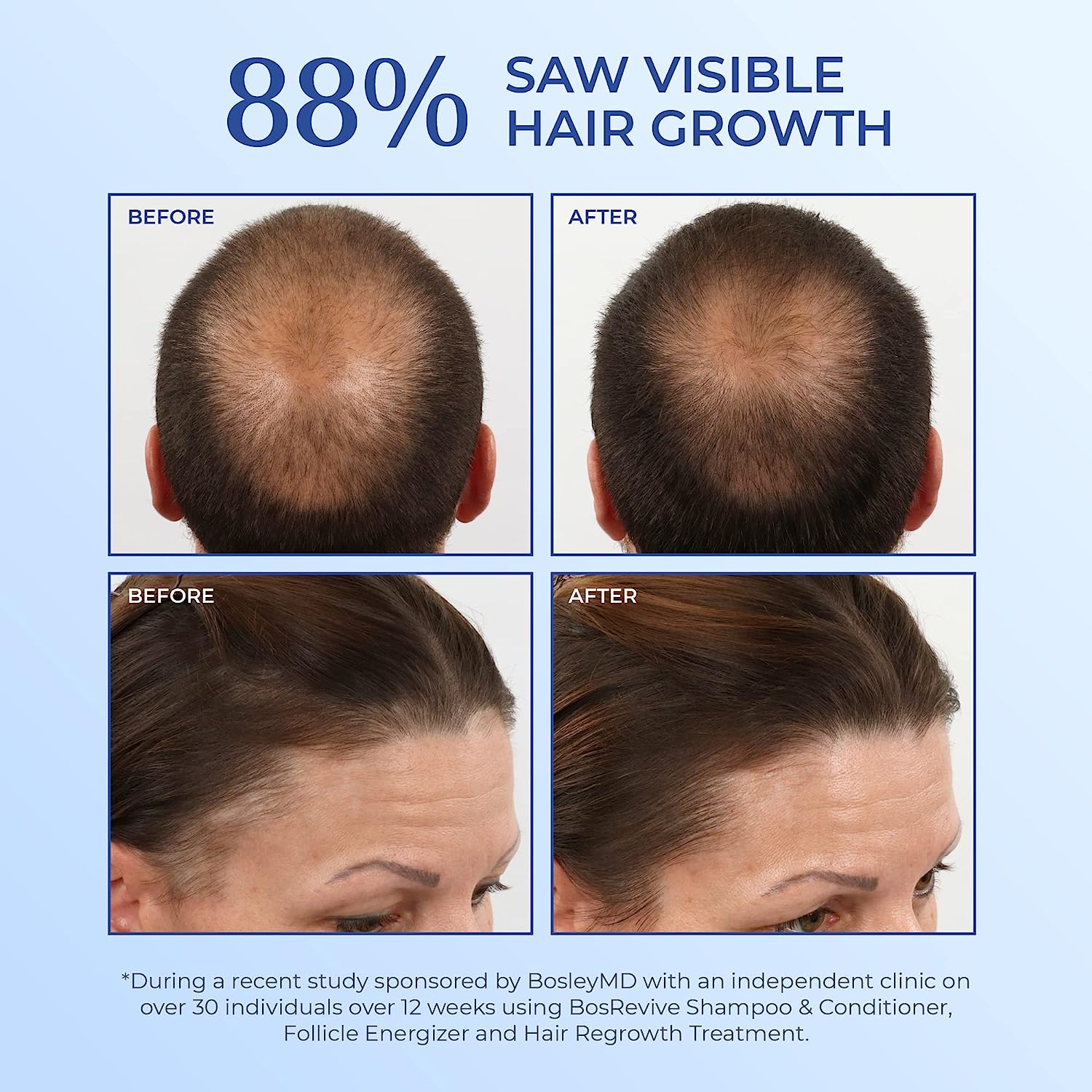 Bosley MD Revive Volumizing Conditioner for Non Color-Treated Hair, 10.1.oz - Reverse Generation Established in 2008